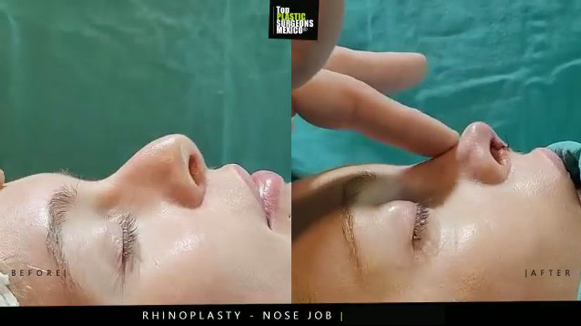 Nose Job - Rhinoplasty in Mexico - TopPlasticSurgeonsMexico 9